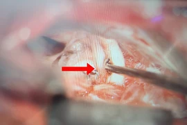 Điều trị thành công cho bệnh nhân mắc chứng co giật nửa mặt