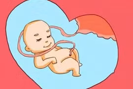 Nguyên nhân gây dây rốn quấn cổ thai nhi 