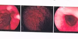 Xạ trị hết 2 loại ung thư ở bệnh nhân tai biến mạch máu não 