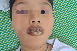 Tự dùng thuốc ho, sốt tại nhà trẻ 11 tuổi lở loét niêm mạc nặng