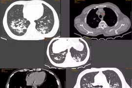 Sút cân, ho kéo dài... nào ngờ mắc phổi không lao NTM