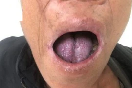 Tái sinh lưỡi của bệnh nhân sau cắt bỏ ung thư