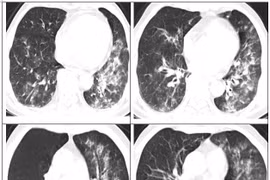 Nhiều người tự chữa cúm A khiến phổi đông đặc, suy hô hấp phải nhập viện 