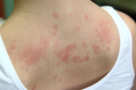 Cô gái mắc hội chứng dị ứng hiếm gặp với... mọi thứ