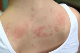 Cô gái mắc hội chứng dị ứng hiếm gặp với... mọi thứ