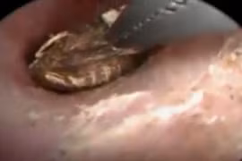 Kinh hãi nhện sống, giăng tơ trong lỗ tai cô gái