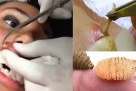 Kinh dị dòi làm tổ trong đôi môi cô gái 