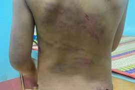 Bé gái 7 tuổi nghi bị bạo hành ở Bình Phước sống cùng mẹ và cha dượng