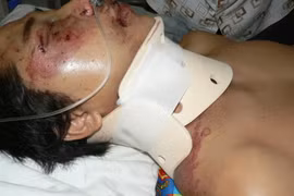 Rượt đuổi gây thương tích, công an viên vào tù