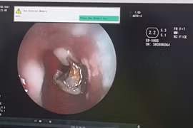 Người đàn ông bị 4 chiếc răng giả lọt vào phế quản khi ho