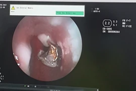 Người đàn ông bị 4 chiếc răng giả lọt vào phế quản khi ho