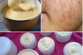 Mách bạn cách nhận biết kem trộn có chứa corticoid nguy hại da 