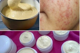 Mách bạn cách nhận biết kem trộn có chứa corticoid nguy hại da 