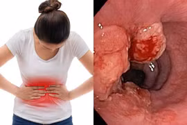 Đi khám vì đau bụng, thiếu nữ 16 tuổi phát hiện ung thư dạ dày di căn