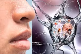 Chú ý dấu hiệu đơn giản này cảnh báo bệnh Parkinson cực kỳ nguy hiểm