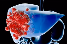 Cả đời không lo ung thư gan khi dành 1 phút làm điều này