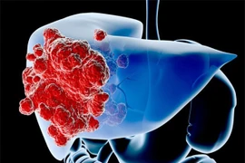 Cả đời không lo ung thư gan khi dành 1 phút làm điều này