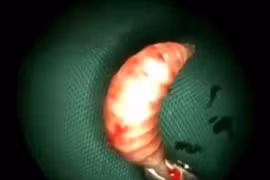 50 con giòi nấp trong mũi, làm mặt người biến dạng