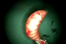 50 con giòi nấp trong mũi, làm mặt người biến dạng