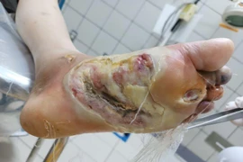 Loét toàn bộ chân vì chiếu tia hồng ngoại chữa tê bì