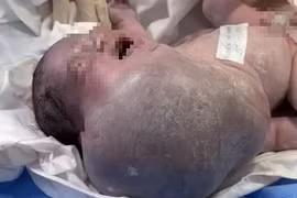 Phẫu thuật khối u vùng mặt, cổ, ngực lớn nhất y văn thế giới