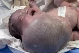 Phẫu thuật khối u vùng mặt, cổ, ngực lớn nhất y văn thế giới