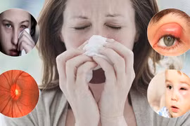 Suýt mù mắt vì biến chứng viêm xoang