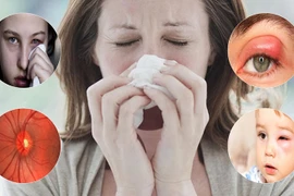 Suýt mù mắt vì biến chứng viêm xoang