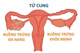 buồng trứng đa nang