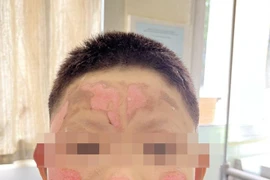 Trẻ 8 tuổi bỏng khắp mặt vì nghịch bật lửa