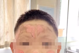 Trẻ 8 tuổi bỏng khắp mặt vì nghịch bật lửa