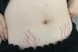 Chăm nhỏ thuốc mũi: Cô gái 23 tuổi bị lùn và lão hóa sớm