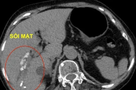 Tán sỏi mật qua da giúp bảo tồn mật