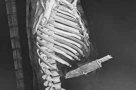 Cứu bệnh nhân bị dao dài hơn 20cm cắm xuyên thấu bụng