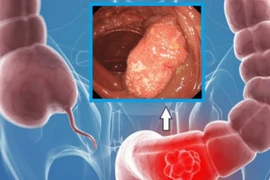 Đối tượng dễ mắc ung thư đại trực tràng, cần phát hiện sớm
