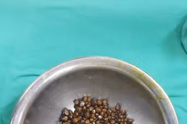 Sỏi mật được lấy ra từ một bệnh nhân