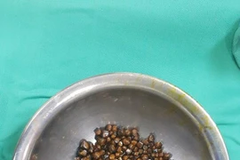 Sỏi mật được lấy ra từ một bệnh nhân