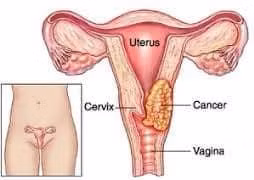 Phụ nữ trẻ muốn sàng lọc ung thư cổ tử cung hãy làm cách này