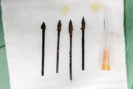 3 chuyên khoa hợp sức cứu trẻ bị 4 mũi tên đâm giữa mặt