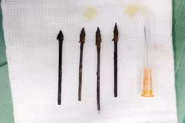 3 chuyên khoa hợp sức cứu trẻ bị 4 mũi tên đâm giữa mặt