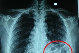 Bóng khí của đại tràng ở trên ngực trái trên X - quang