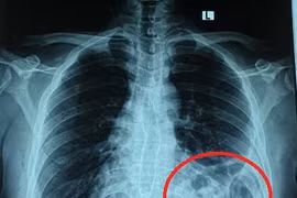 Bóng khí của đại tràng ở trên ngực trái trên X - quang