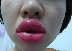 Biến chứng khi xăm môi