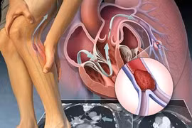 Địa chỉ vàng: Các bệnh viện tuyến đầu điều trị tắc động mạch chi