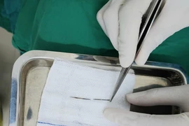 Đi chữa gãy xương phát hiện kim may áo quần trong nhu mô phổi