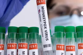 Người mắc bệnh Đậu mùa khỉ đầu tiên tại Việt Nam là nữ