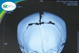 Lần đầu tiên: Trẻ 17 tháng tuổi mổ khe hở sọ mặt phức tạp, hiếm gặp