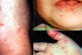 7 bệnh nguy hiểm ai cũng có thể mắc trong mùa hè