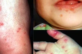 7 bệnh nguy hiểm ai cũng có thể mắc trong mùa hè