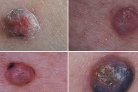 Cách nhận diện u ác tính giống hệt mụn thường